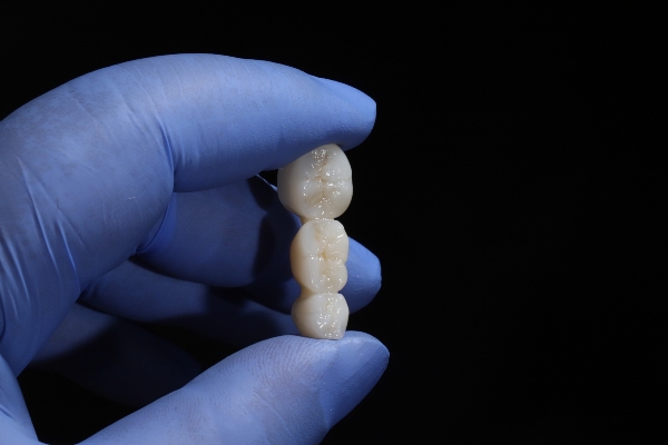 Porcelain Vs Metal Dental Crowns: Which One Is Right For You?