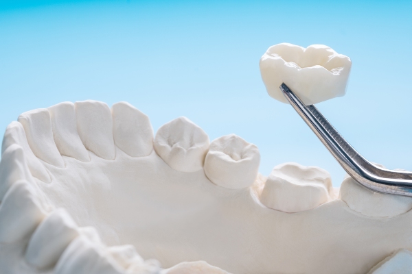 When Is A Dental Crown Needed After A Root Canal?